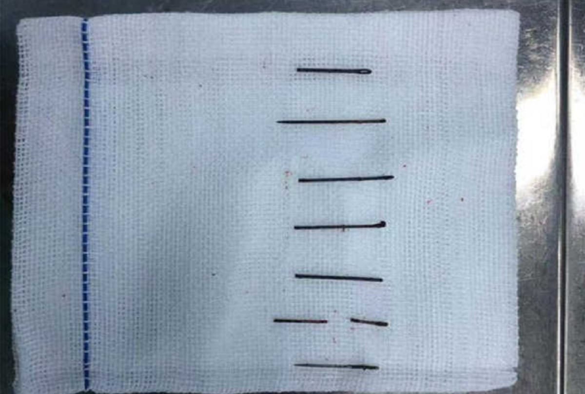 Doctors remove 8 metal needles from chinese mans butt who stuck for 10 years