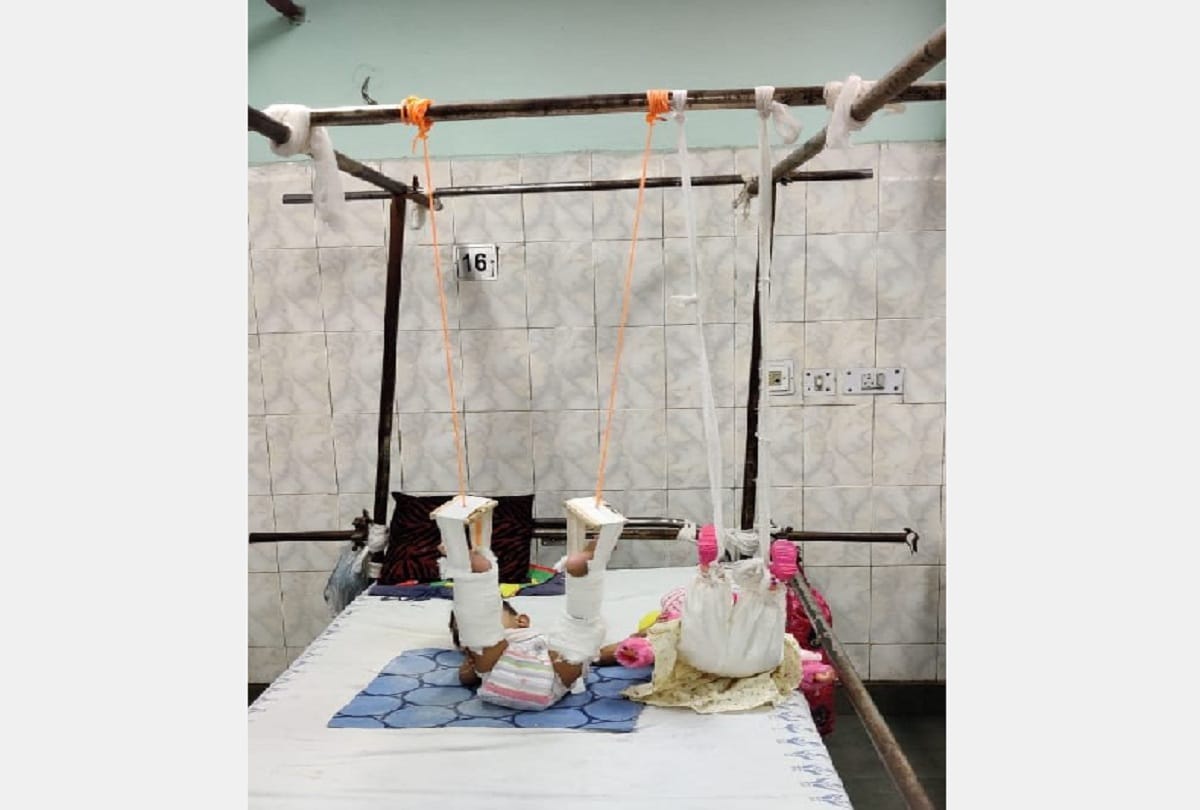 treatment of baby girl with help of doll in lok nayak hospital will study doctors