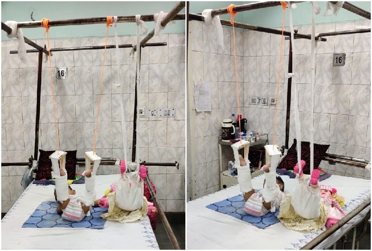 treatment of baby girl with help of doll in lok nayak hospital will study doctors