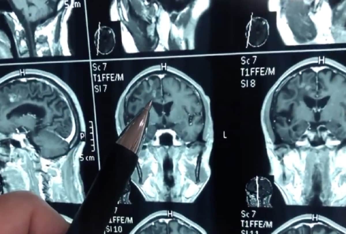 Worm lived in mans brain for 30 years causing headaches and seizures in China