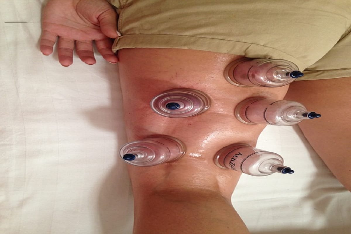 celebrities uses cupping therapy, it gives you relief from pain, anxiety and many more