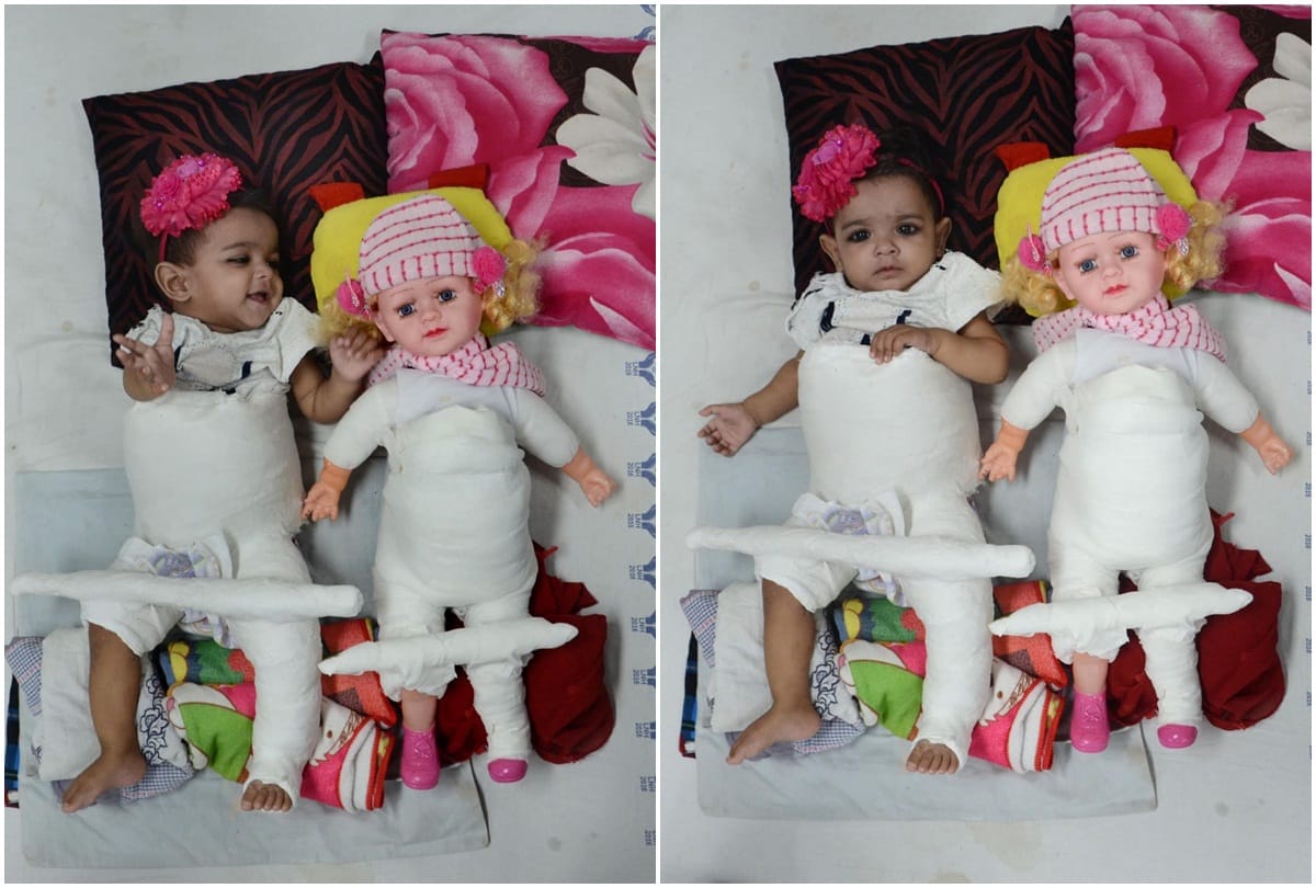 baby zikra her doll return home from lok nayak hospital doctor say its example for medical science