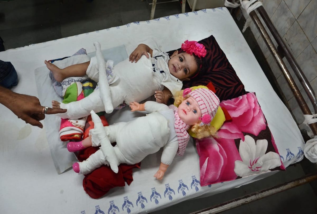 Delhi News: Doctor First Plaster to Doll then Baby Zikra in Lok Nayak Hospital