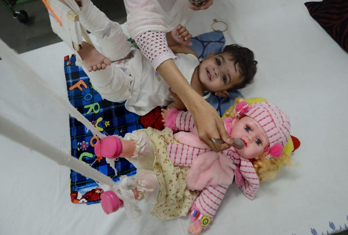 Delhi News: Doctor First Plaster to Doll then Baby Zikra in Lok Nayak Hospital