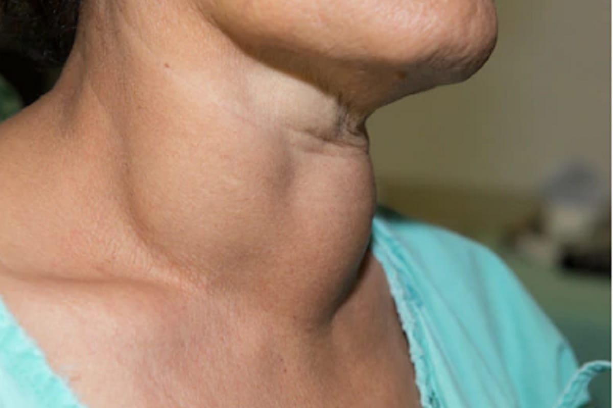 know about lipoma, its causes, symptoms and treatment