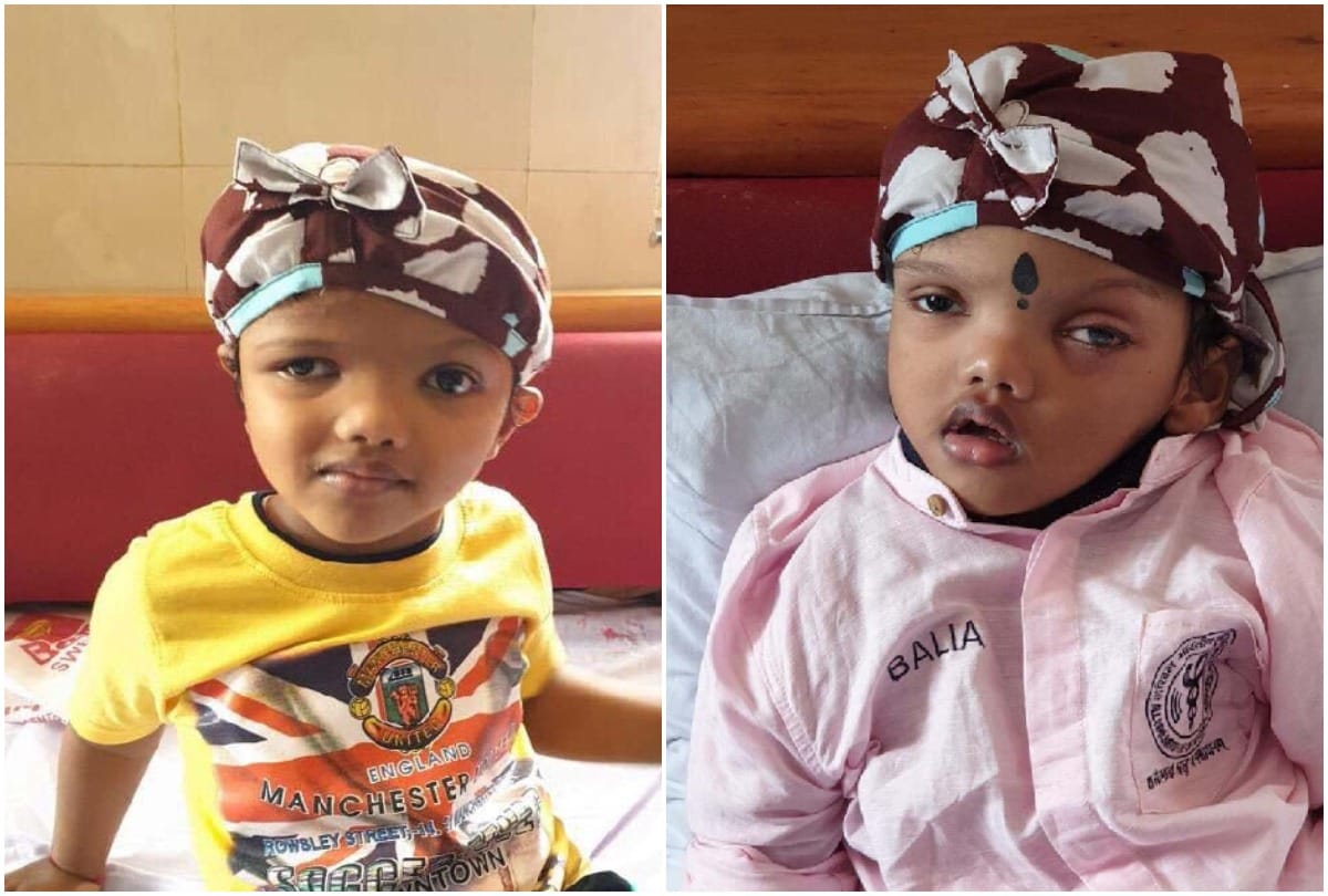 twin bothers rare medical case in aiims 