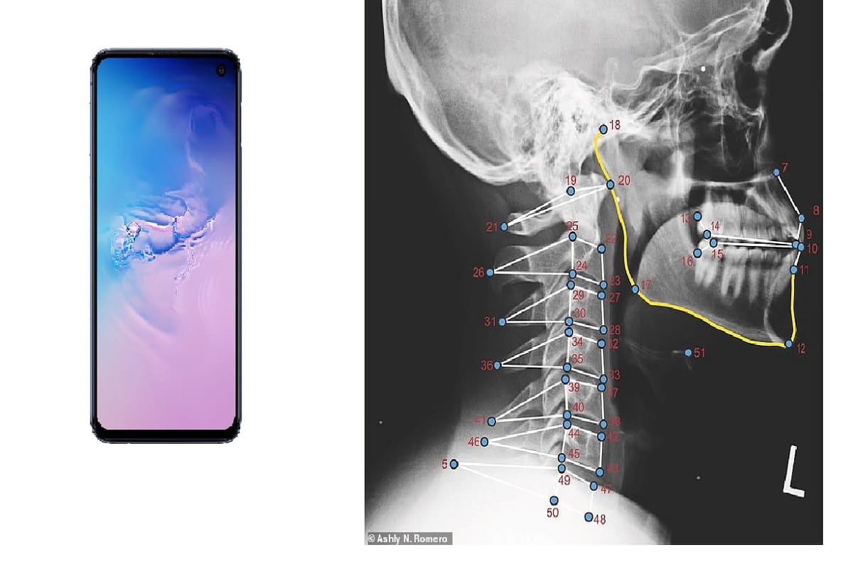 Women suffer more neck pain than men because of using smartphone