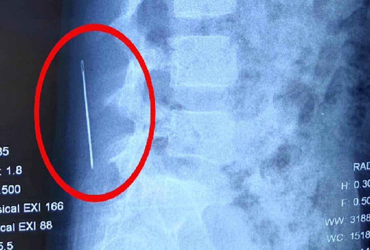 AIIMS got the operation done again after needle not found in Nehru Hospital