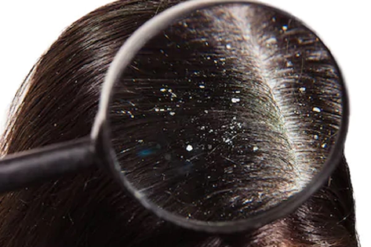 benefits of salt, get rid of dandruff and hair problem
