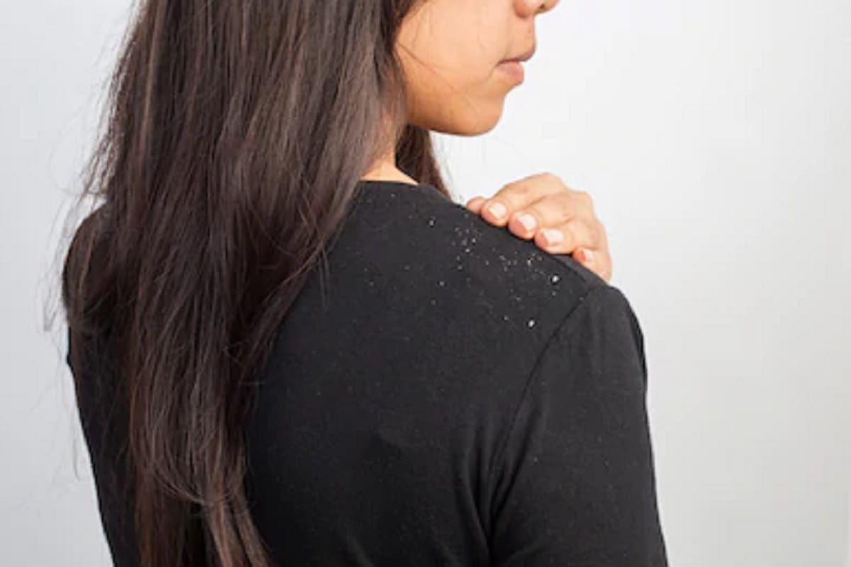 home remedies and therepy to reduce hair fall and baldness