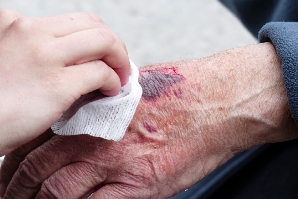 world sepsis day 2019: causes, symptoms and cure of sepsis