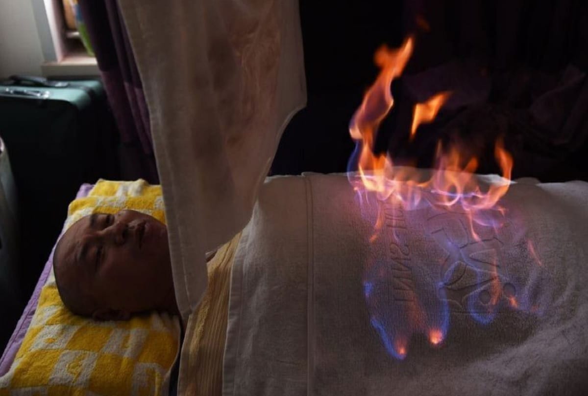 Fire Therapy in china Sets Patients Up In Flames To Cure Chronic Illness
