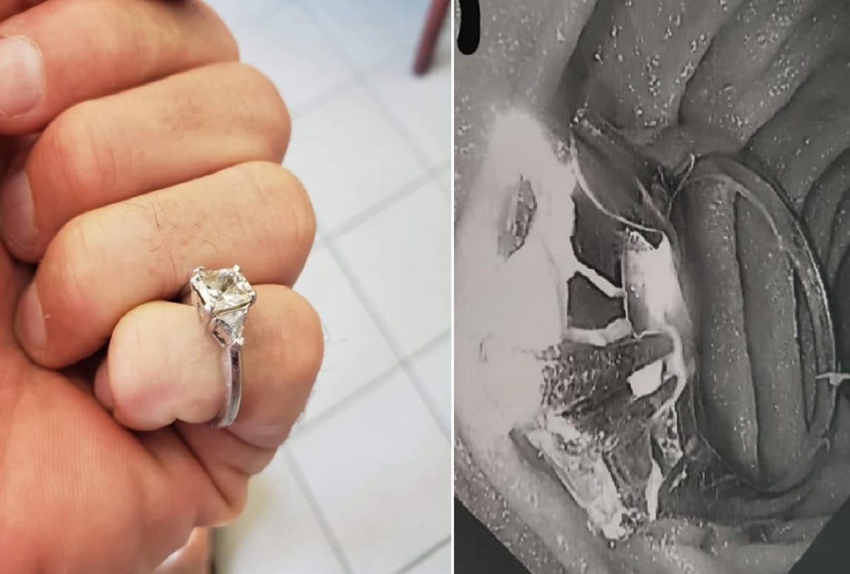 woman accidentally swallowed her engagement ring in her sleep doctors removed