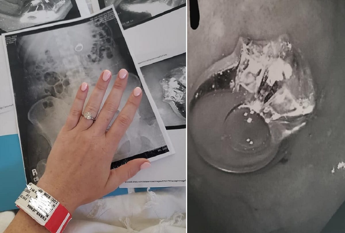 woman accidentally swallowed her engagement ring in her sleep doctors removed