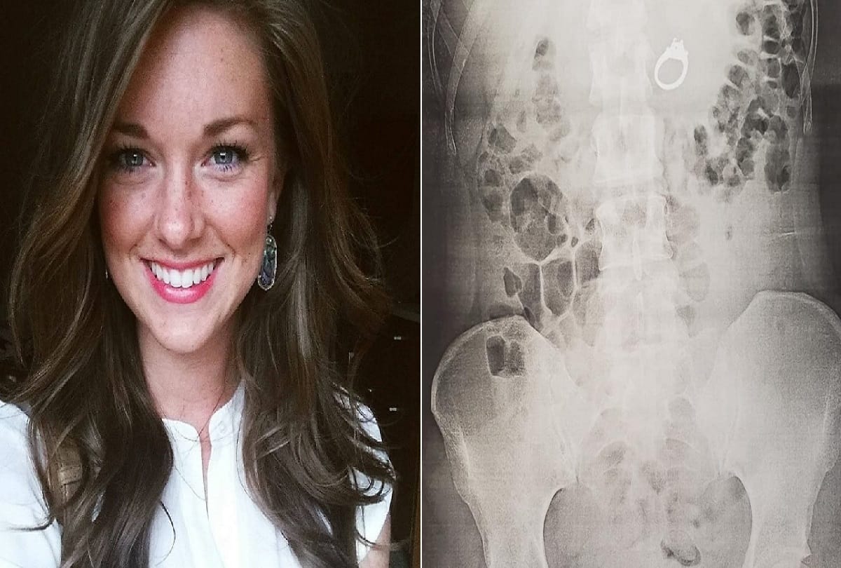 woman accidentally swallowed her engagement ring in her sleep doctors removed