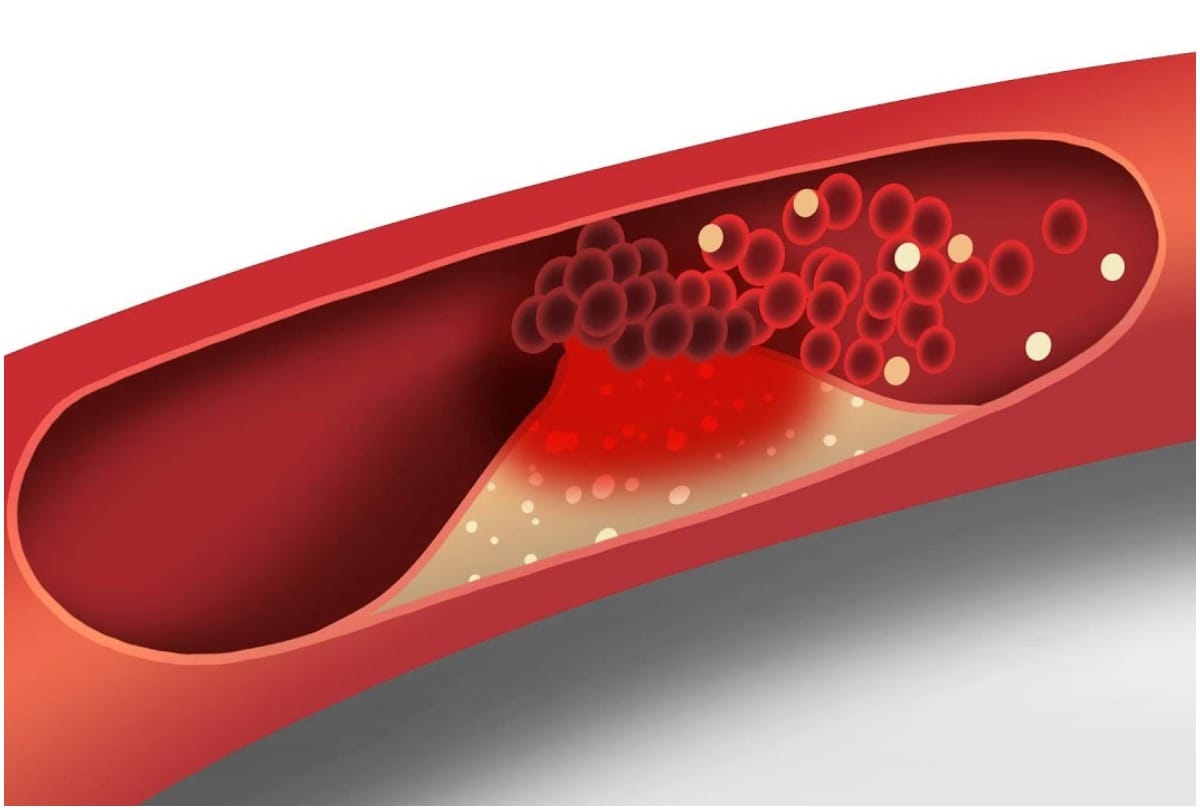 statins medicine could reduce the severity of covid-19, study says