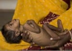 Four children died due to malnutrition in the district