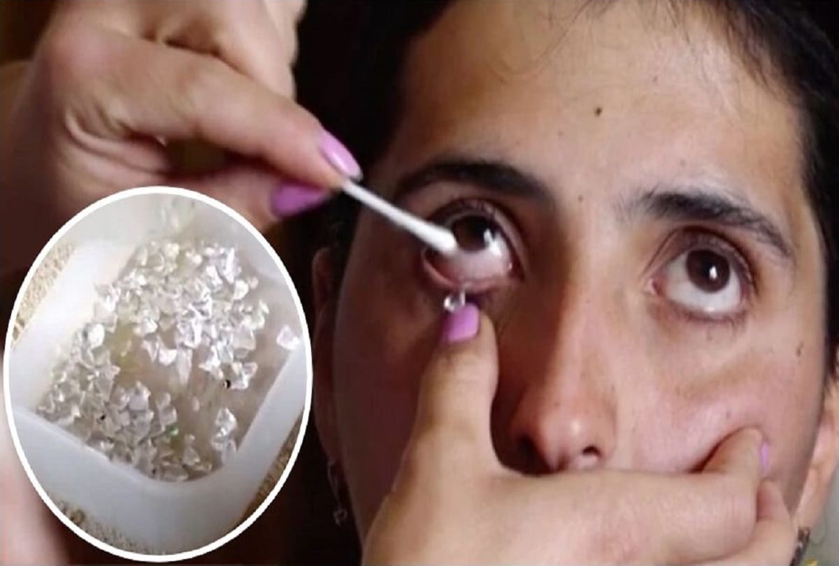 Strange medical case of a woman who cries crystal tears every day
