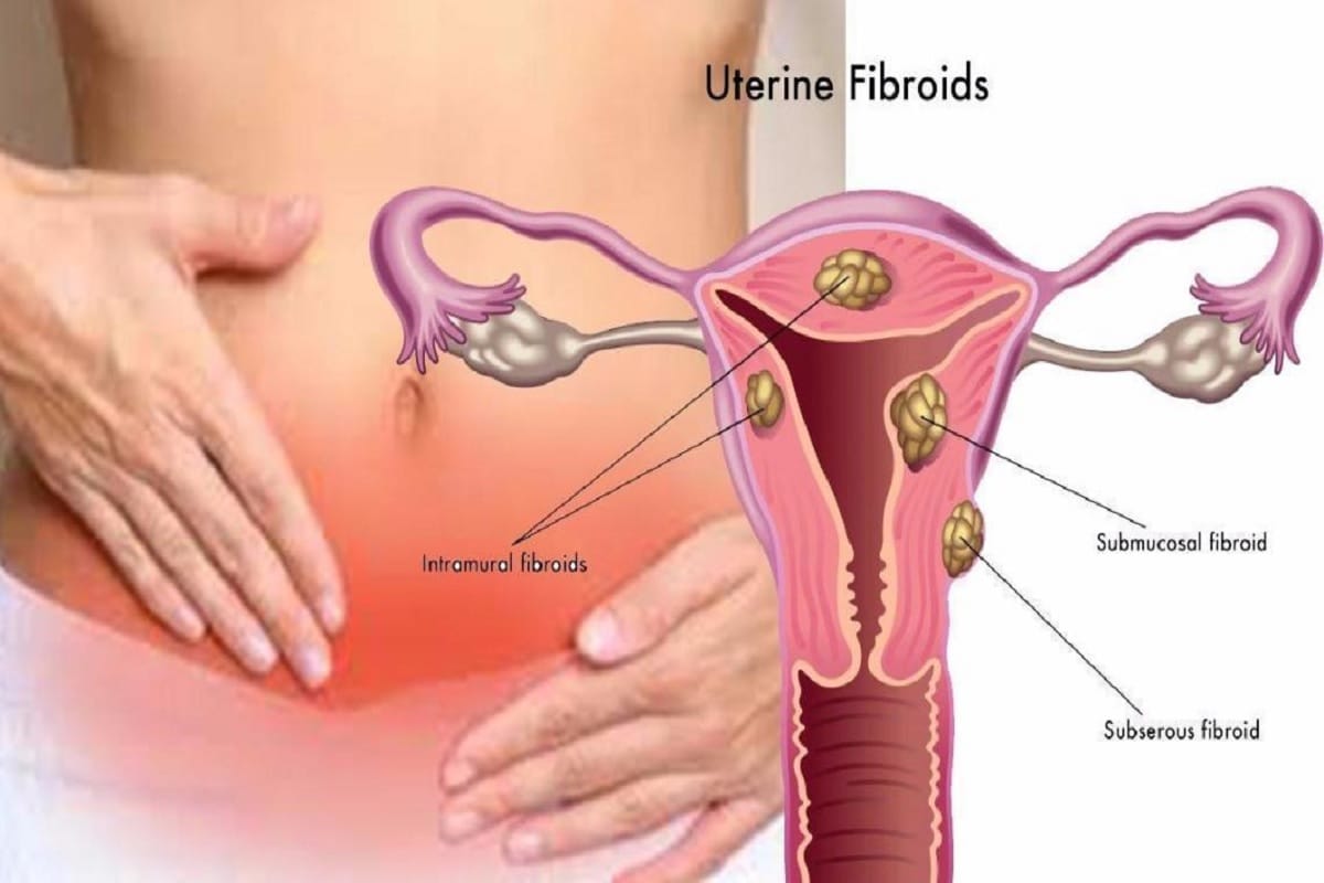 lumps made in utrus rsoli causes prevention with food