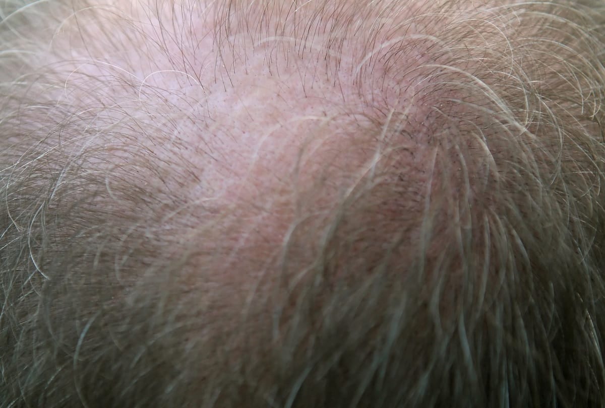 A hat that zaps the scalp could helps reverse male balding