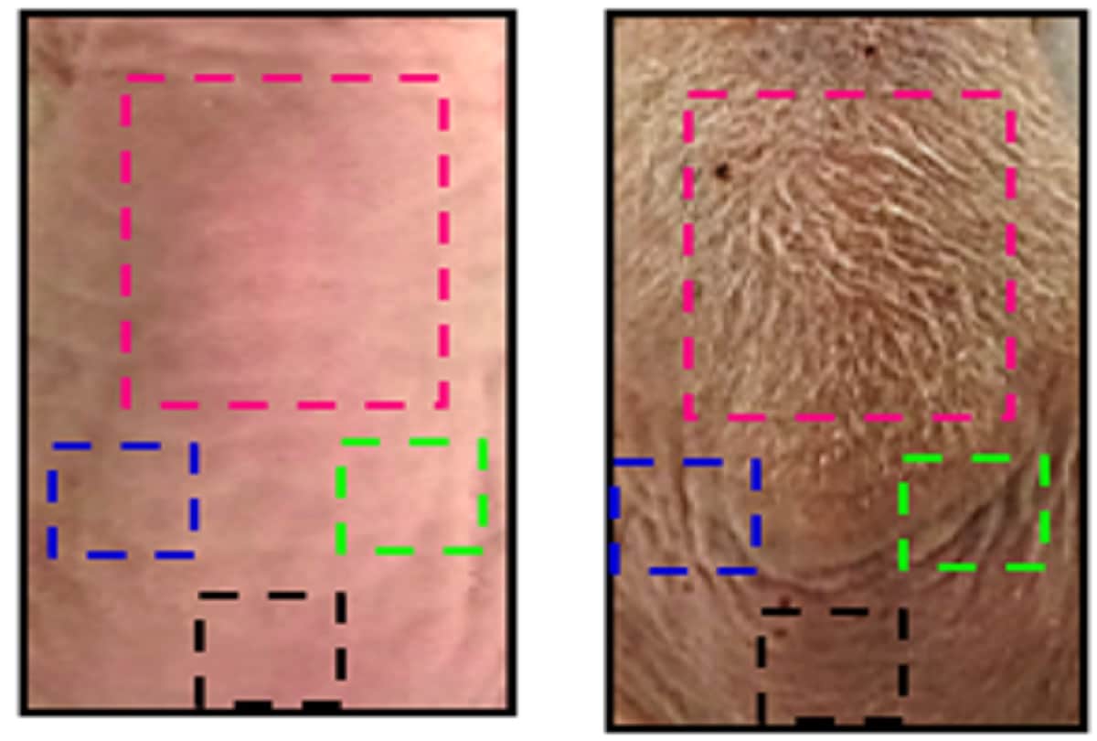 A hat that zaps the scalp could helps reverse male balding