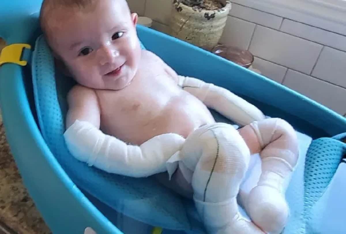 Baby suffering rare skin disease parents can not hugged him because his skin falls off