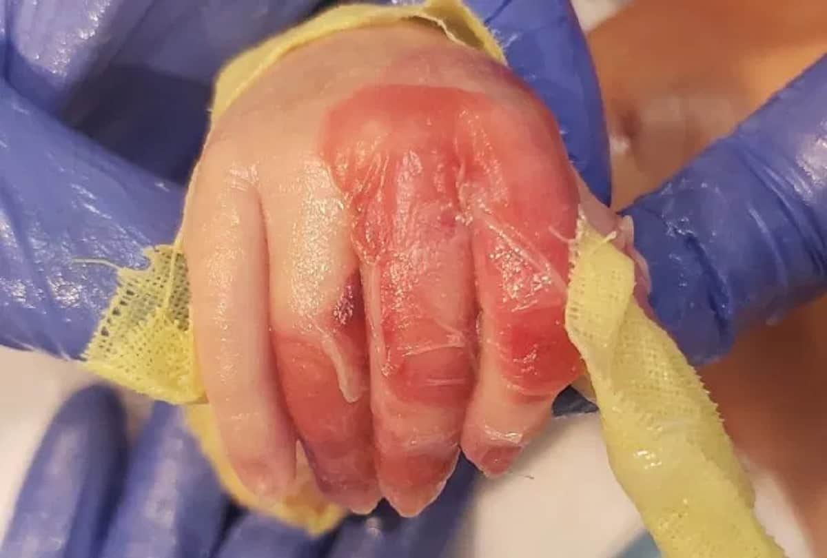 Baby suffering rare skin disease parents can not hugged him because his skin falls off