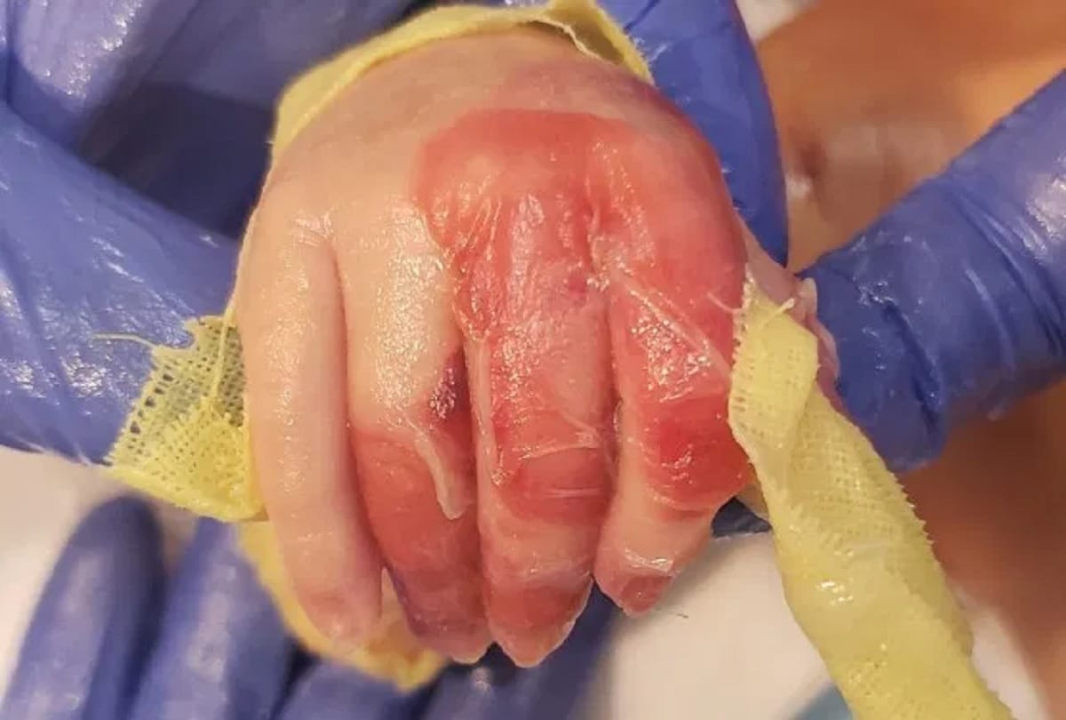 Baby suffering rare skin disease parents can not hugged him because his skin falls off