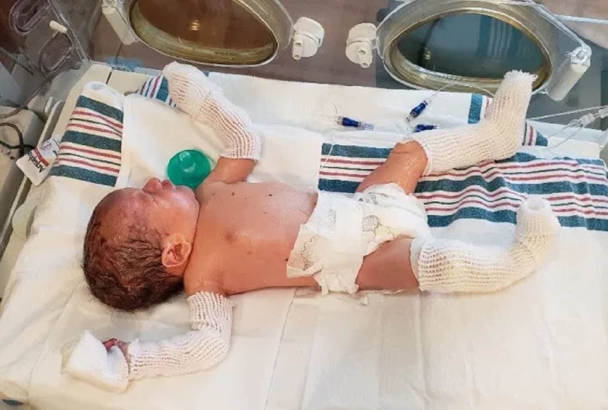 Baby suffering rare skin disease parents can not hugged him because his skin falls off