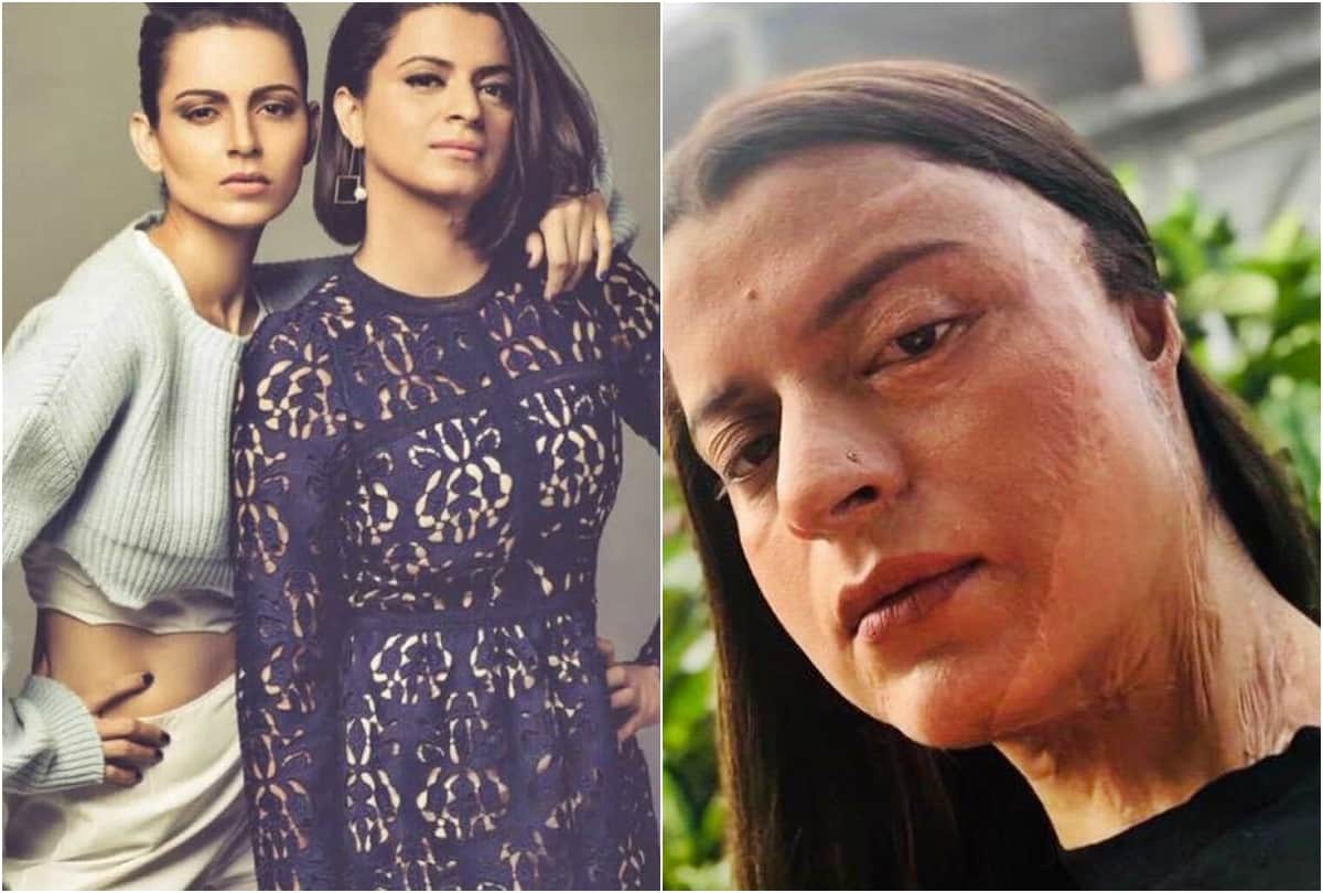 Rangoli tweet about Acid Attack also Mention how even Kangana Ranaut was Physically Assaulted