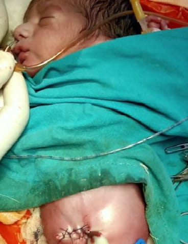 doctor saved life of a newborn by operation