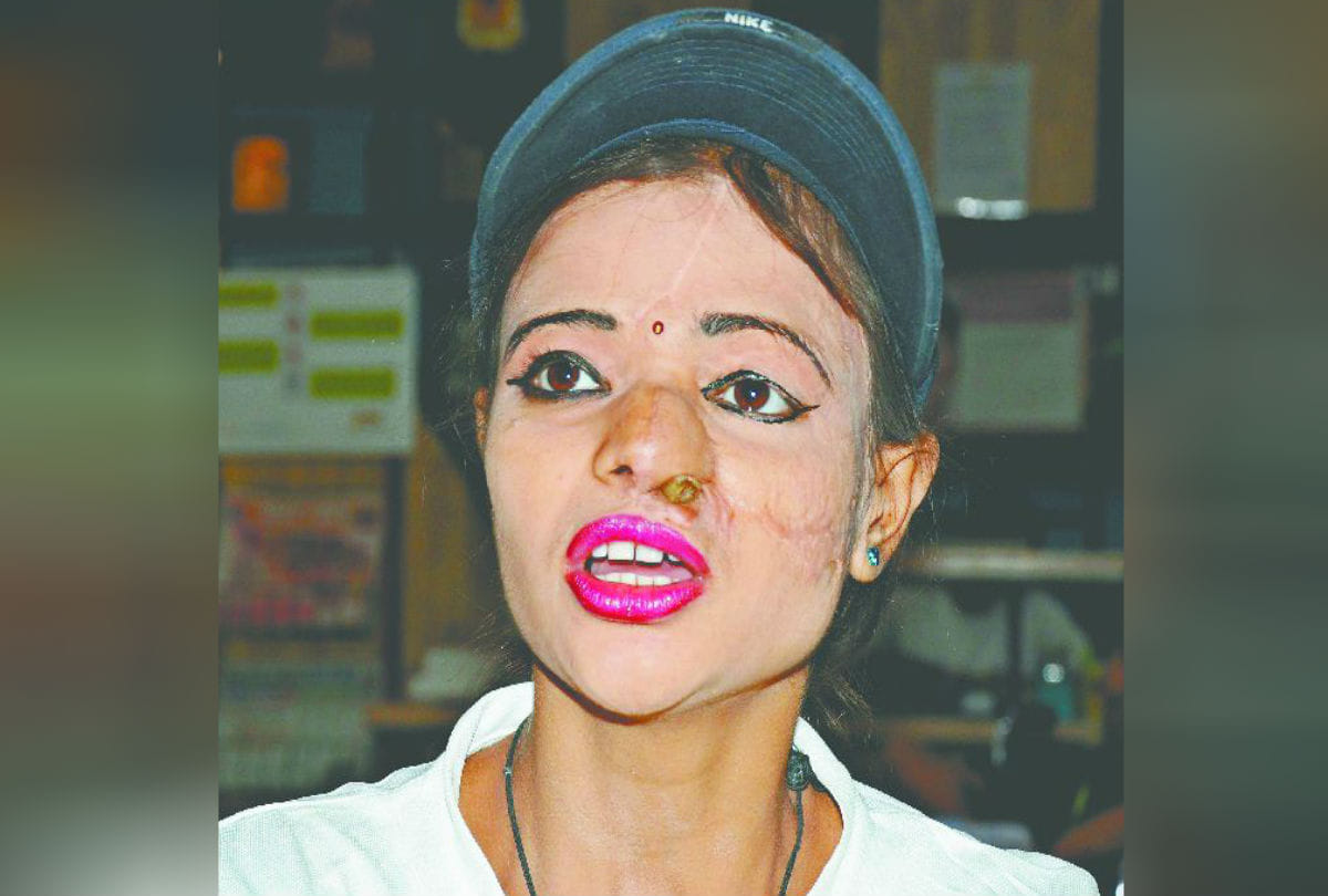 Acid attack victims Says on Ravan Dahan Agra News in Hindi