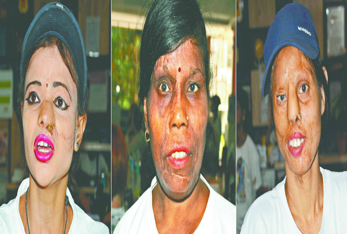 Acid attack victims Says on Ravan Dahan Agra News in Hindi
