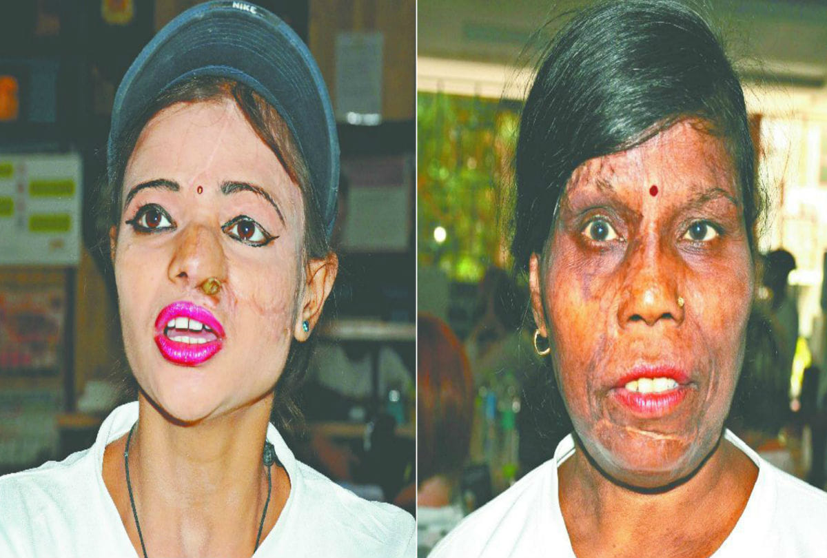 Acid attack victims Says on Ravan Dahan Agra News in Hindi