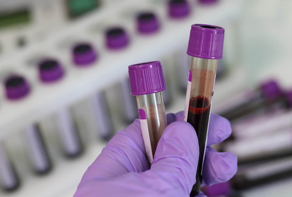 Which blood group is risk for cancer, Pancreatic Cancer and risk factors
