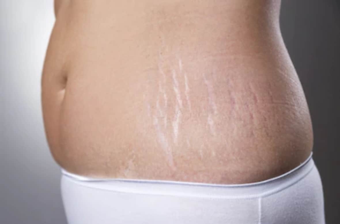 How To Hide Stretch Marks With Makeup Know Methods In Hindi