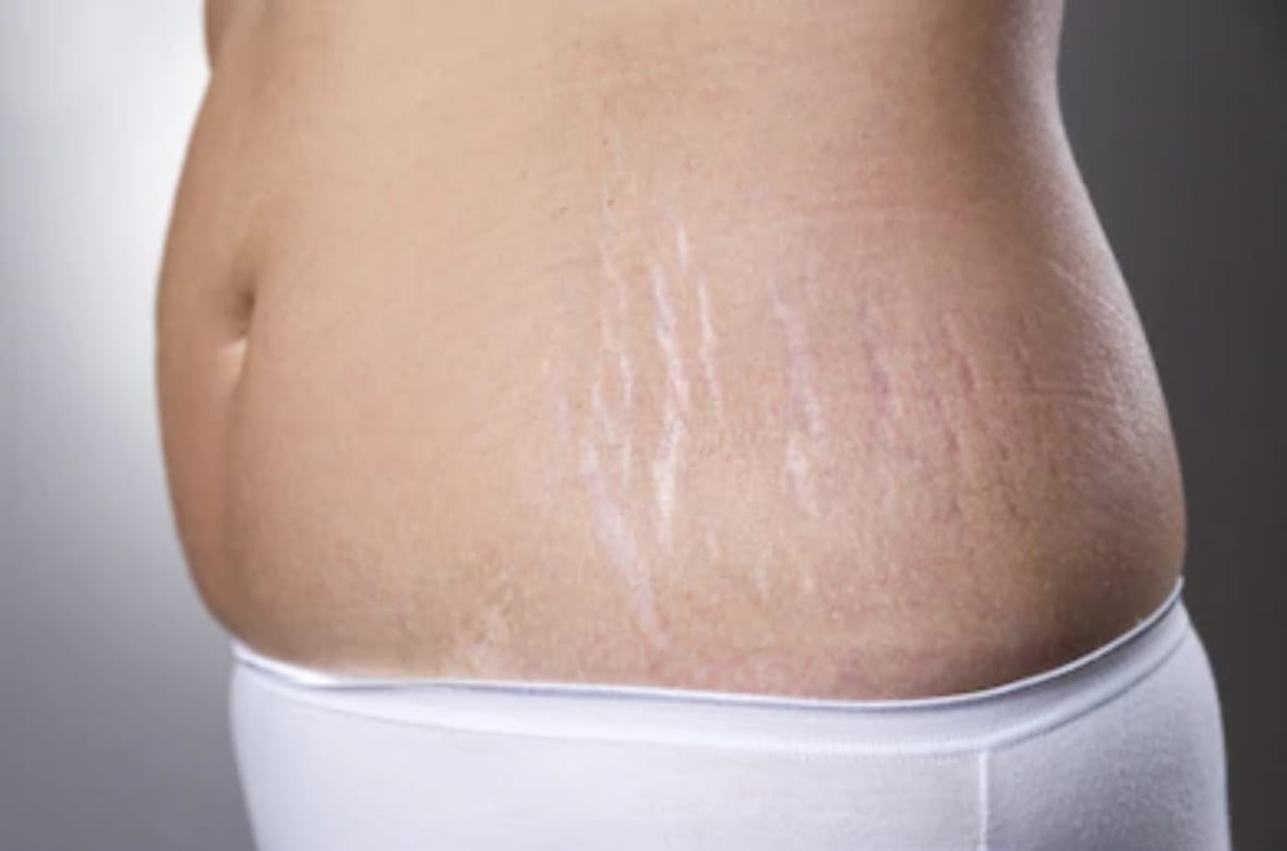 How To Hide Stretch Marks With Makeup Know Methods In Hindi