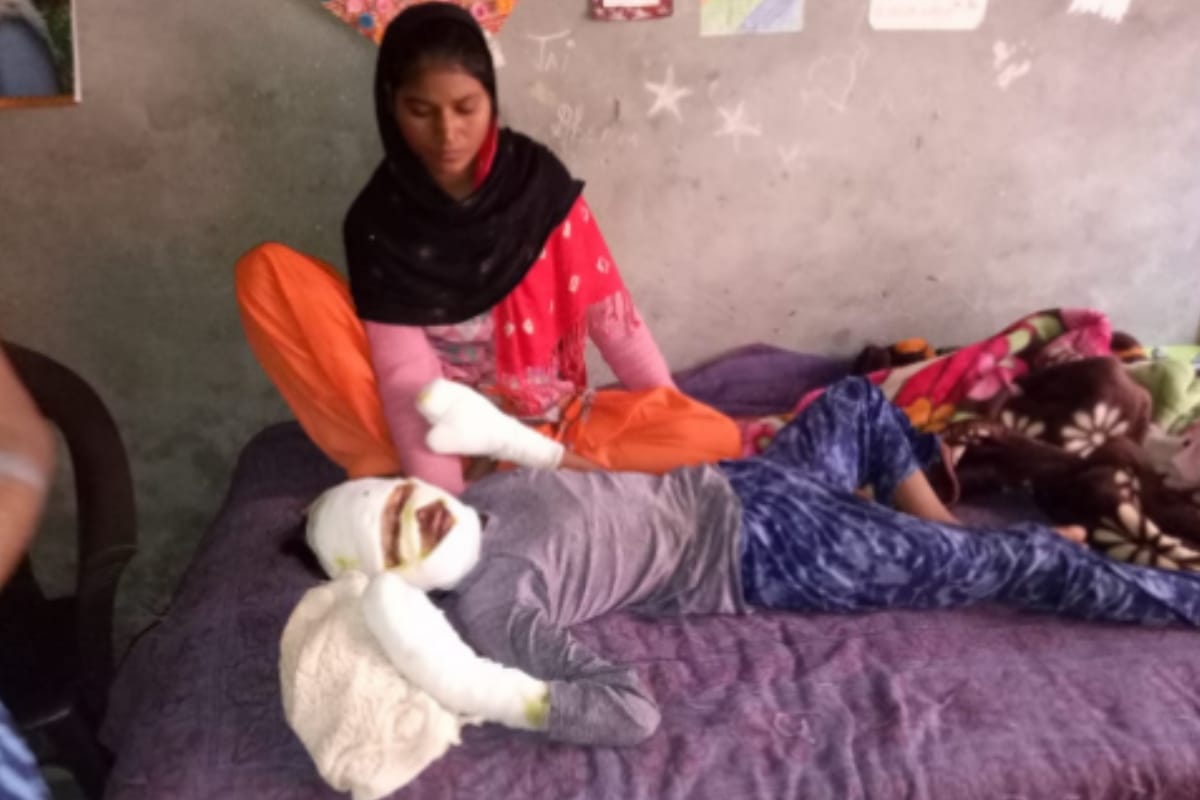 Meerut, Two teenager injured after a sudden explosion in a gift pack kept outside the house