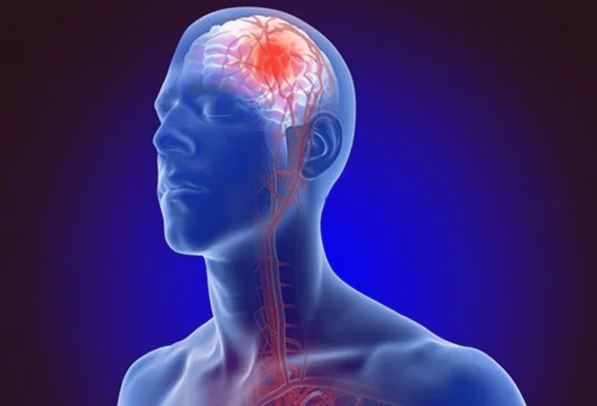 world stroke day 2019 symptoms and treatment