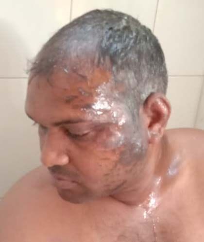 Neighbors threw acid on the young man for preventing him from taking possession of disputed land