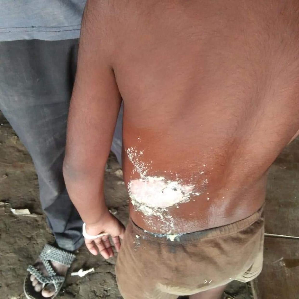 Boiling milk spilled on the student in school