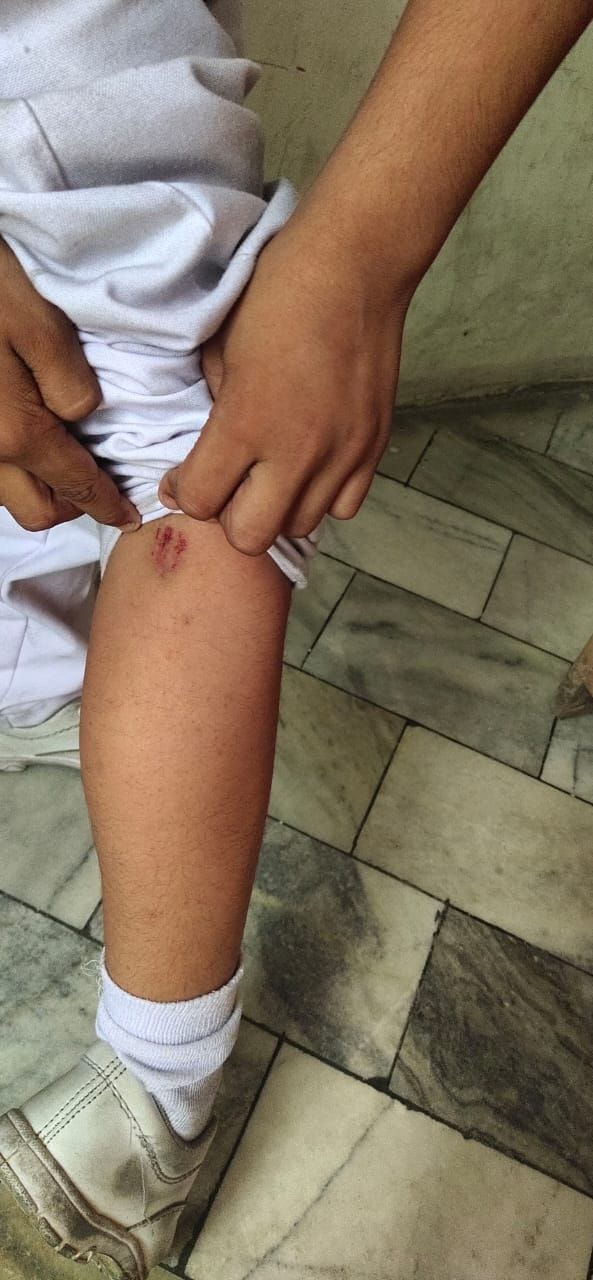 sarpanchs son attacked by dogs, 20 year old girl saved her life