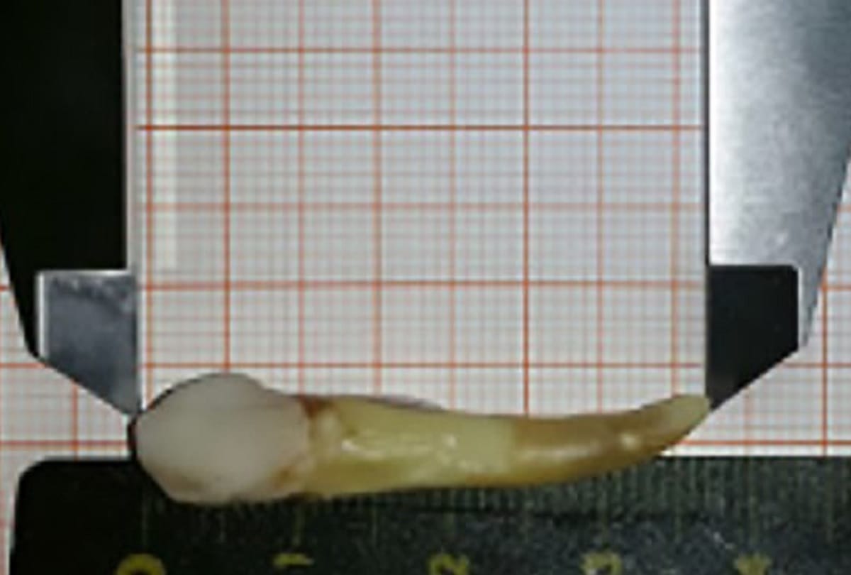 Dentist pulls out the worlds longest tooth from a patient in Germany