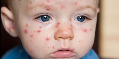 Kerala witnessing surge in chickenpox cases know symptoms and prevention tips in hindi