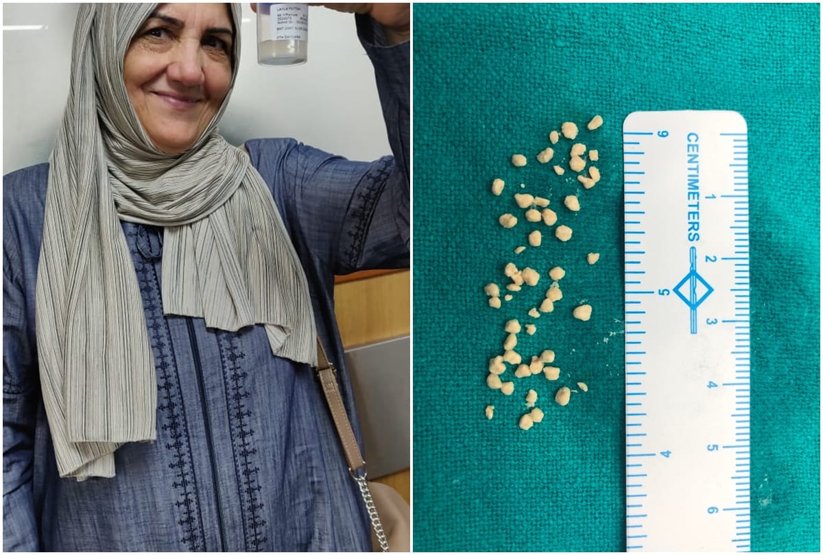 53 stones taken out of thin tube of spit of Iraqi woman, doctors said challenge