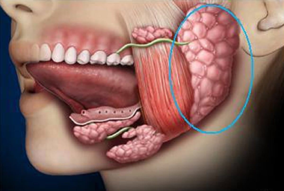 53 Stones removed from Iraqi woman salivary duct in Delhi Hospital