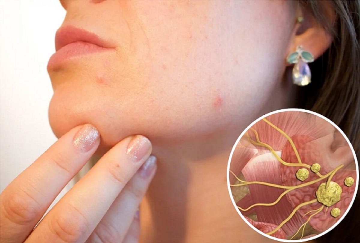 53 Stones removed from Iraqi woman salivary duct in Delhi Hospital