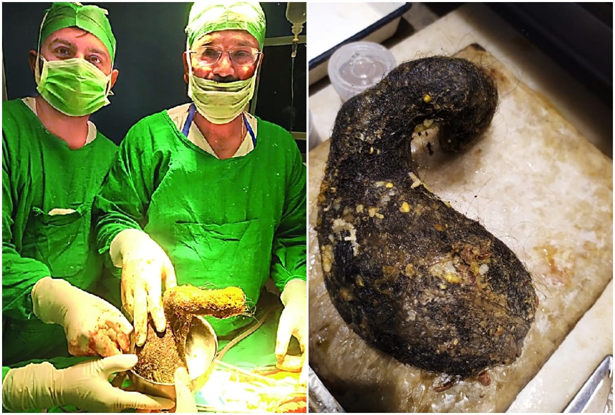 Bunch of two kilograms of hair from patient stomach in jhansi