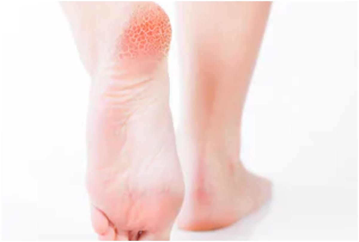 daily heel care routine for cracked heel