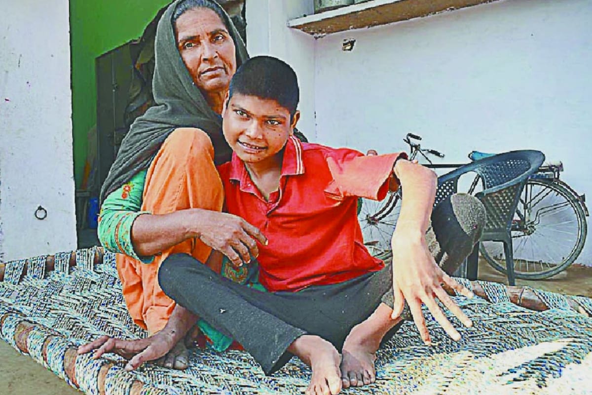 Life of children suffering from malnutrition becomes difficult